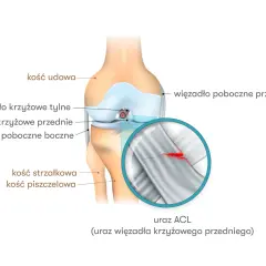 Anatomia kolana z zaznaczonym urazem ACL (przedniego więzadła krzyżowego). Widoczne kości i więzadła.