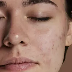 Primo piano del viso di una giovane donna con diversi tipi di imperfezioni viso, tra cui brufoli e macchie rosse.