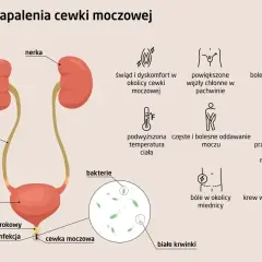 Objawy zapalenia cewki moczowej: pieczenie, ból, gorączka, krew w moczu, bolesny wytrysk. Infekcja bakteryjna cewki moczowej.