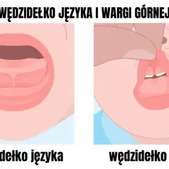 Podcięcie wędzidełka: Kiedy ćwiczyć, a kiedy sport? Poradnik