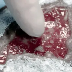 Rękawiczka dotyka rany z widocznym krwawieniem i tkanką. To może być efekt urazu lub zabiegu, który wymaga dalszej pielęgnacji.