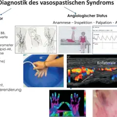 Die entscheidenden Schritte zur Diagnose des Flush-Syndroms verstehen