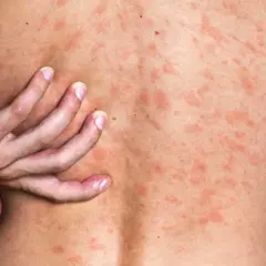 Une main gratte le dos couvert de plaques rouges, signe d'urticaire après la douche.