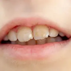 Jak wyleczyć próchnicę bez dentysty i uniknąć bólu zębów