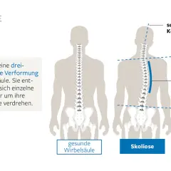 Vergleich einer gesunden Wirbelsäule mit einer Skoliose, die einen Rippenbuckel und schiefe Schultern verursacht.