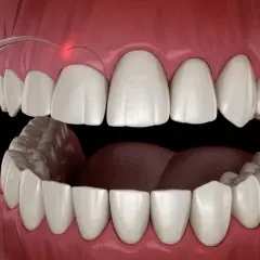 Zabieg gingiwektomii laserem: precyzyjne modelowanie dziąseł dla pięknego uśmiechu.