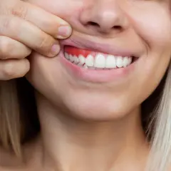 Una persona se tira del labio superior para mostrar sus encías, que están rojas e inflamadas, indicando la falta de encias sanas.