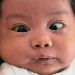 Primo piano di un neonato con strabismo. Un occhio guarda dritto, l'altro è deviato verso l'esterno.