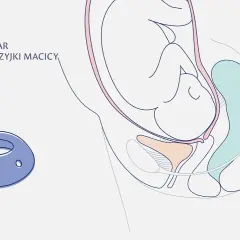 Skracanie szyjki macicy w ciąży: Jak zapobiec przedwczesnemu porodowi?