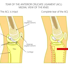 Anatomia kolana: zerwane więzadło krzyżowe przednie (ACL) powoduje przesuwanie się kości. Ltc kolano co to jest – ilustracja pokazuje uszkodzenie ACL.