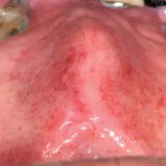 Palato con diffuse lesioni mucosa orale, petecchie rosse e aree infiammate.