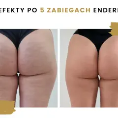 Endermologia: co to, jak działa i czy warto? Pełny przewodnik