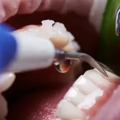 Dettaglio di una pulizia denti professionale con strumento odontoiatrico.