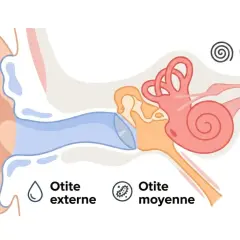 Schéma de l'oreille montrant l'otite externe, moyenne et interne. Une otite chez l'adulte peut affecter différentes parties de l'oreille.