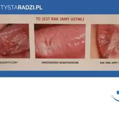 Rak dziąseł: jak wygląda? Zdjęcia i objawy, które musisz znać