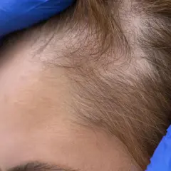 Manos enguantadas revisan la línea del cabello, mostrando una zona con menos densidad. Se investigan soluciones como el colágeno para el pelo.