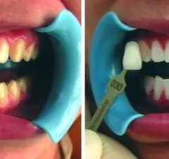 Jak wygląda wybielanie zębów u dentysty? Poznaj szczegóły i efekty