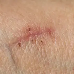 Gros plan d'une cicatrice qui s'ouvre et saigne, avec des points rouges et des fils de suture visibles.
