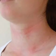 Alergia na pomidory: objawy, krzyżówki i nietolerancja histaminy