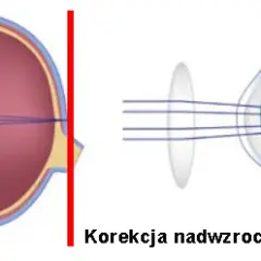 Maksymalna wada wzroku: co musisz wiedzieć o dioptriach i ich skutkach