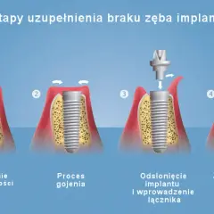 Jak wygląda implant zęba? Wszystko o budowie i procesie wszczepiania