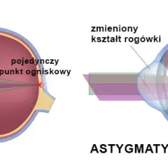 Największa wada wzroku: jakie powikłania grożą Twoim oczom?
