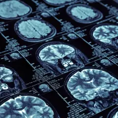 Jak zapobiec Alzheimerowi: Skuteczne metody na zmniejszenie ryzyka