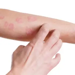 Skutki uboczne po chemii – najczęstsze objawy i jak sobie z nimi radzić
