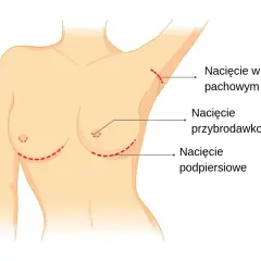 Gdzie zrobić operację biustu? Znajdź najlepsze kliniki w Polsce