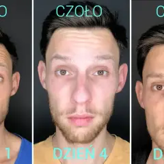 Botoks na lwia zmarszczkę: efekty i czas oczekiwania na rezultaty