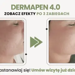 Przed i po zabiegu Dermapen 4.0: widoczne dermapen efekty po 3 zabiegach, skóra wygładzona, bez niedoskonałości.