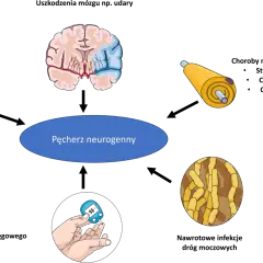 Ilustracja przedstawia przyczyny pęcherza neurogennego: mózg, rdzeń kręgowy, nerw, cukrzycę i bakterie. Czy pęcherz neurogenny da się wyleczyć?