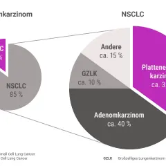 Diagramm zeigt Lungenkrebs-Arten: NSCLC (85%) und SCLC (15%). NSCLC unterteilt in Adenokarzinom (40%), Plattenepithelkarzinom (35%), GZLK (10%) und Andere (15%). Hoffnungsvolle lungenkrebs geheilt erfahrungsberichte sind hier relevant.