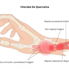 Ilustracja dłoni z zaznaczonym zapaleniem błony maziowej i pochewki ścięgnistej, wskazującym na chorobę De Quervaina.