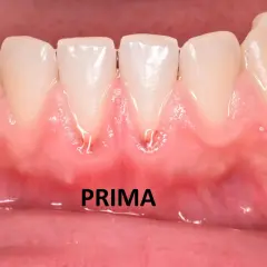 Gengive infiammate e arrossate intorno ai denti anteriori, con segni di recessione gengivale. La parola "PRIMA" indica la situazione iniziale.