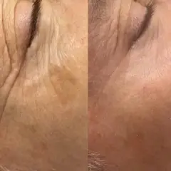 Split image showing before and after of skin treated with fractional CO2 laser, with reduced wrinkles.