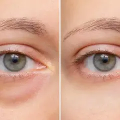 Vorher-Nachher-Vergleich: Deutliche Reduzierung von Augenringen und Schwellungen unter dem Auge.