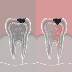 Ilustración muestra cómo es una caries dental, desde una pequeña mancha negra hasta una infección avanzada con pus.