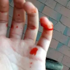 Blutige Hand mit einem offensichtlich gebrochenen Finger. Kleine Schnitte und Blutstropfen auf der Handfläche und den Fingern.