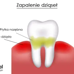 Zapalenie dziąseł? Jak skutecznie leczyć w domu i u dentysty