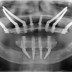 Radiografia panoramica mostra impianti dentali posizionati in arcate mascellari con ridotta quantità di osso, una soluzione per chi necessita di impianti dentali senza osso.