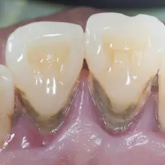 Denti con evidente accumulo di tartaro e infiammazione gengivale, segni di paradontosi dentale.