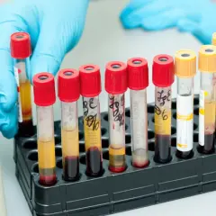 Rękawiczka w niebieskiej rękawiczce umieszcza probówki z krwią w stojaku. Wyniki badań krwi mogą wskazać, jaki poziom żelaza jest niebezpieczny.