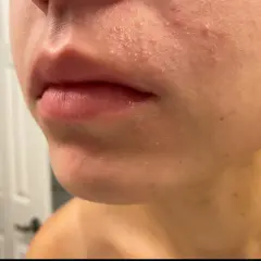 Närbild på mun och haka med rodnad och små utslag, tecken på elidel perioral dermatit.