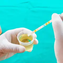 Ręka w rękawiczce zanurza pasek testowy w próbce moczu, badając potencjalne pasma śluzu.