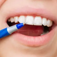 Applicazione di fluoro sui denti con una penna speciale per una protezione duratura.