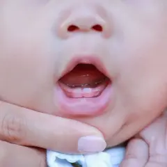 Bocca di neonato con primi dentini spuntati. La dentizione neonato è un momento emozionante per i genitori.