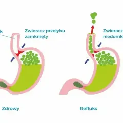 Schemat ukazuje zdrowy żołądek i żołądek z refluksem. Refluks powoduje cofanie się treści żołądkowej, co może wywołać uczucie guli w gardle.