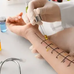 Lekarz od alergii wykonuje testy skórne na przedramieniu pacjenta, aplikując krople płynów z fiolek.