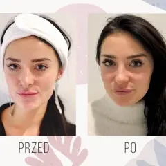 Pielęgnacja ust po kwasie hialuronowym: Mniej obrzęku, trwały efekt